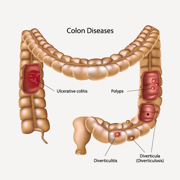 diseased colon